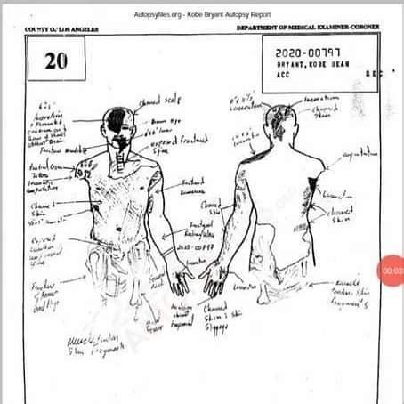 gigi autopsy sketch|Gigi Autopsy Report PDF: Analysis of Gigi Autopsy。